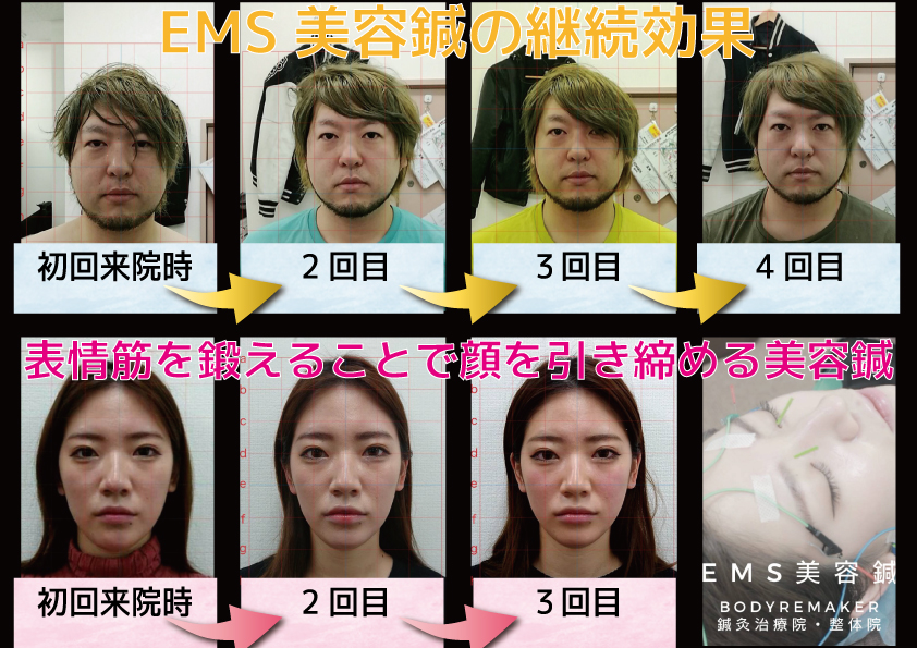 EMS美容鍼による小顔効果